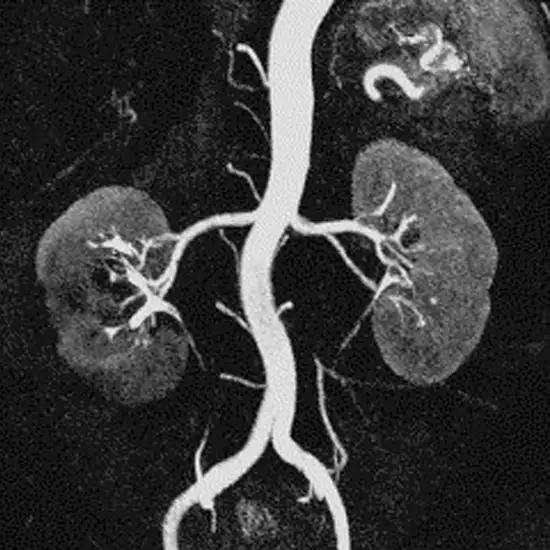 MR Angiography Renal With Contrast